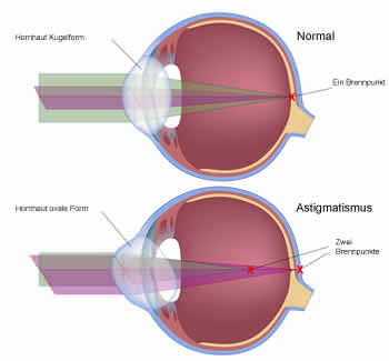 Auge mit Hornhautverkrümmung / Astigmatismus als Schaubild im Vergleich zum normalen Auge