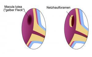 Netzhautforamen