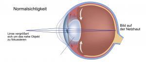 Altersichtigkeit - vorher