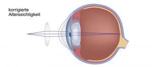 Altersichtigkeit - korrigiert
