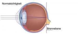 Normalsichtigkeit