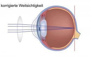 Weitsichtigkeit - korrigiert