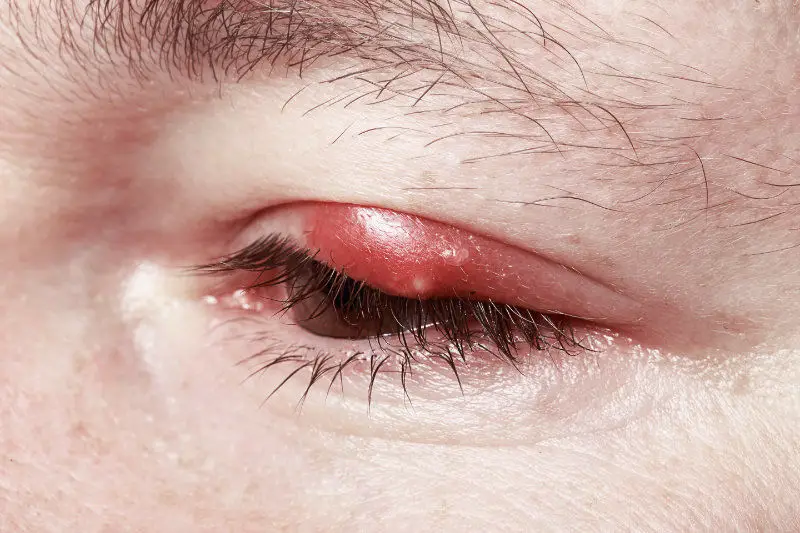 Chalazion Hagelkorn