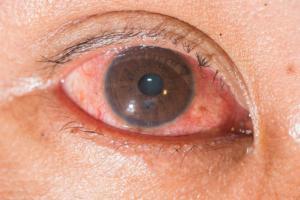Augengrippe